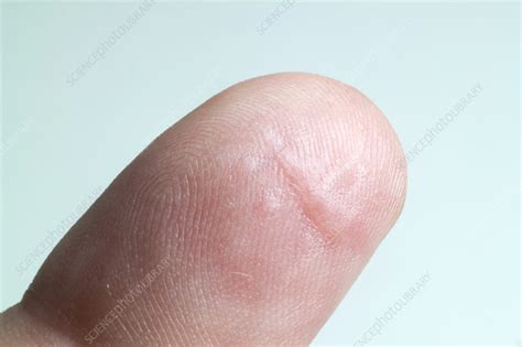 Healing Cut Day 28 - Stock Image - C001/5403 - Science Photo Library