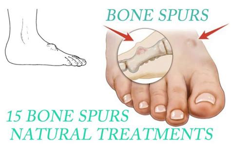 15 Bone Spurs (Neck And Knee) Natural Treatments That Work