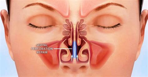 Repair Septal Perforations - Pacific Eye & Ear Specialists