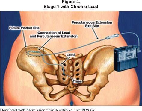 Figure 4 from Sacral nerve neuromodulation (InterStim). Part I: Review of the InterStim system ...