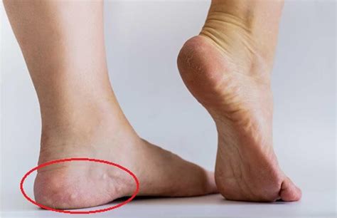 Pedal Piezogenic Papules: Causes, Symptoms & Treatment