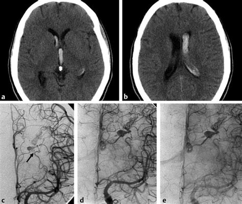 9: The Anterior Choroidal Artery | Radiology Key