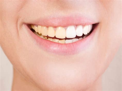 Understand What Causes Teeth Stains and How to Prevent It
