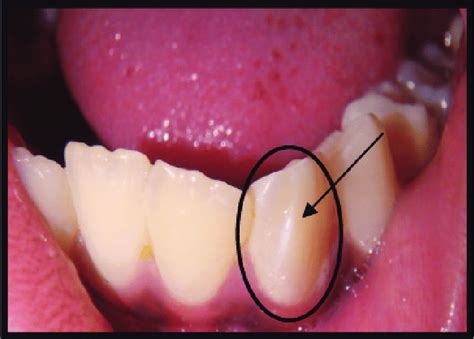 Labial view of 33 showing talon cusp | Download Scientific Diagram