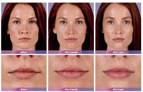 Juvederm Ultra Plus Before And After Lipstick | Lipstutorial.org