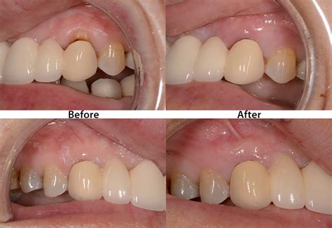 Receding Gum Lift Procedure - Ohio Cosmetic Dentists Columbus Ohio