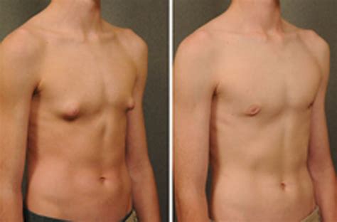 Gynecomastia