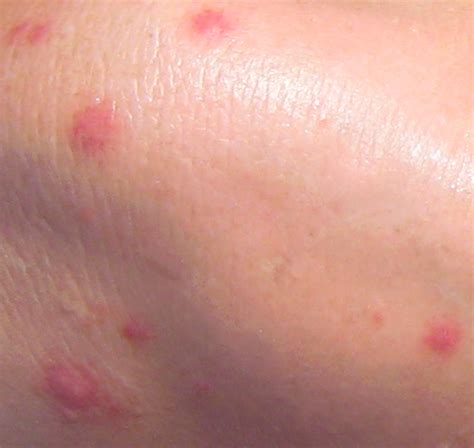 Mosquito Bites - Pictures