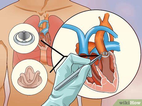 How to Treat an Adult Heart Murmur: 9 Steps (with Pictures)