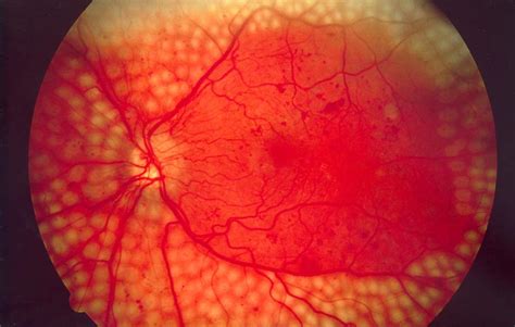 Diabetic retinopathy - Wikipedia