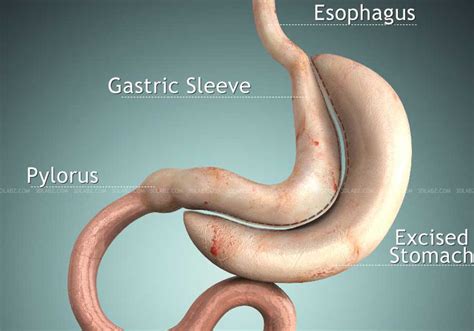 Gastric Sleeve