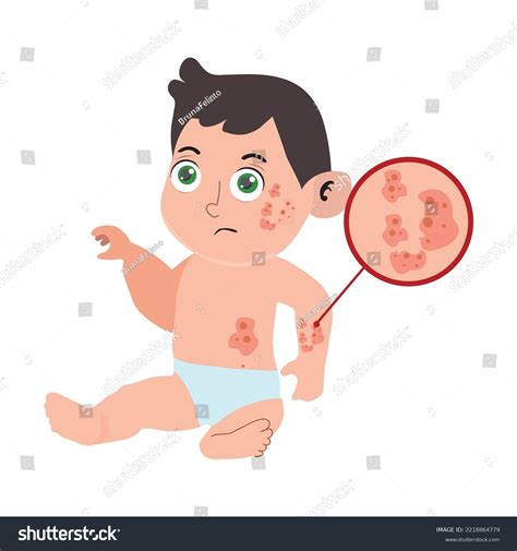 Baby Having Eczema Skin Problem On Stock Vector (Royalty Free) 2218864779 | Shutterstock