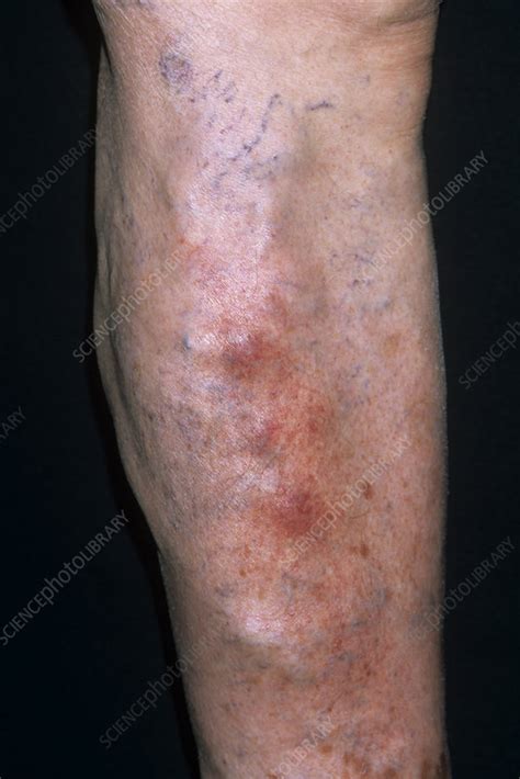 Superficial thrombophlebitis - Stock Image - M175/0450 - Science Photo Library