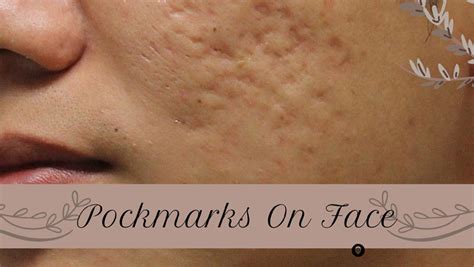 Pockmarks On Face - Meaning, Causes, & Best Treatments