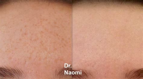 Freckle Removal - Best Cosmetic Clinic Sydney. Advanced practitioners