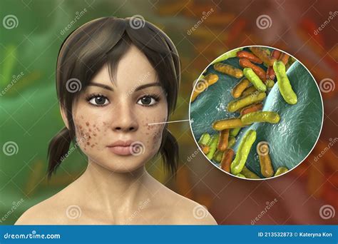 Acne Vulgaris on Skin and Closeup View of Bacteria Cutibacterium Acnes Stock Illustration ...