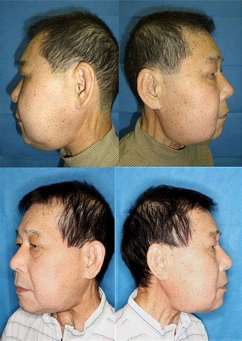 Figure 4 from Lymphaticovenous anastomosis for facial lymphoedema after ...