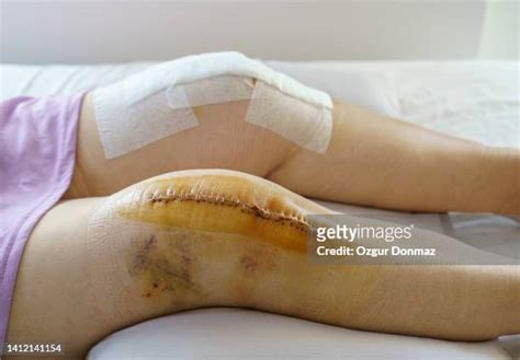 72 Knee Surgery Scar Stock Photos, High-Res Pictures, and Images ...