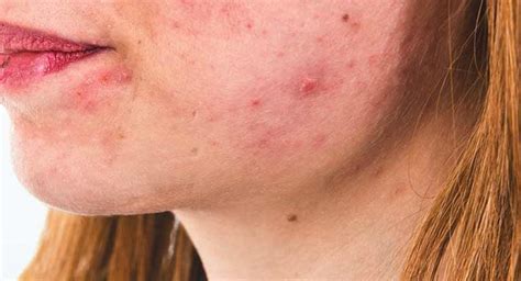 Accutane Side Effects: What Are They?