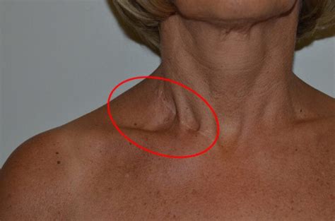 Cindy SAPL p att 3 neck 2 | Lymphedema & Lipedema Center