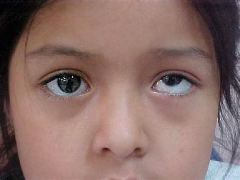 Eye 2 Eye Optometrists: Vertical Strabismus ----- Definition,Types,Treatment and Management