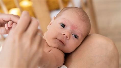 Baby acne vs eczema: Expert on difference between the two | Health ...