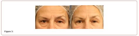 Facial Nerve Paresis Functional and Aesthetic Improvement with Min- Invasive Methods | Iris ...