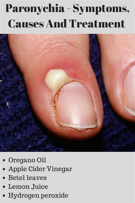 What Is The Nail Bed Infection at Tabitha Yagi blog