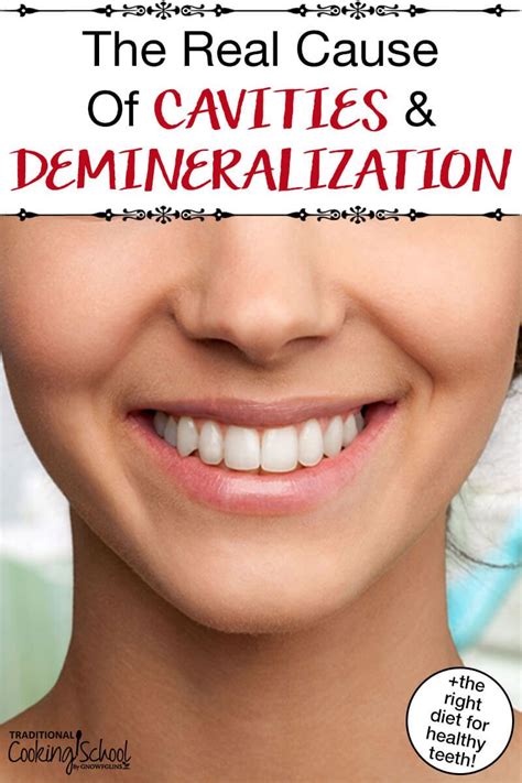 The Real Cause Of Cavities & Demineralization + The Right Diet for Healthy Teeth | Receding gums ...