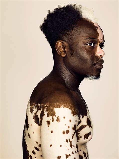 finding beauty in difference: model bashir aziz opens up about living with vitiligo - i-D