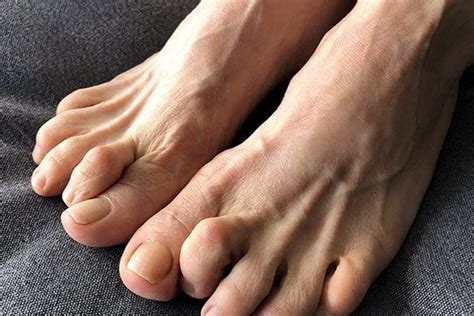 Claw Toe Treatment & Claw Foot | The Foot Practice Singapore