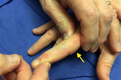 SPRAIN, PIP JOINT | Hand Surgery Resource