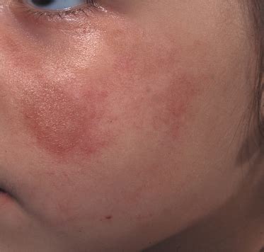 Early Scleroderma Skin Rash