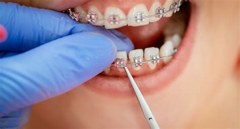 Power Chain Braces - Everything You Need To Know - Dr Braces