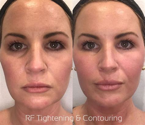 RF Microneedling Before And After Photo Gallery Orlando, FL