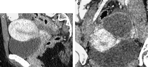 Anatomy, Histology, and Normal Imaging of the Endometrium | Radiology Key