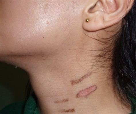 Laser hair removal side effects | How to avoid complications and Risks