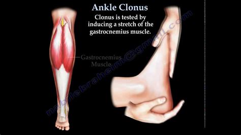 Ankle Clonus - Everything You Need To Know - Dr. Nabil Ebraheim - YouTube