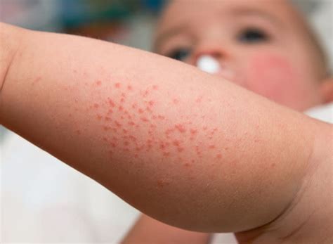 Meningitis Rash On Face / From Meningitis To Eczema And Measles The Ultimate Baby Rash Guide And ...