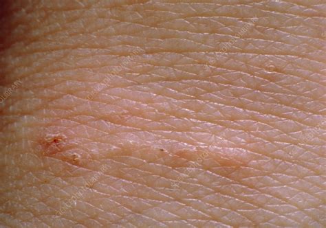 Scabies rash on skin - Stock Image - M260/0040 - Science Photo Library