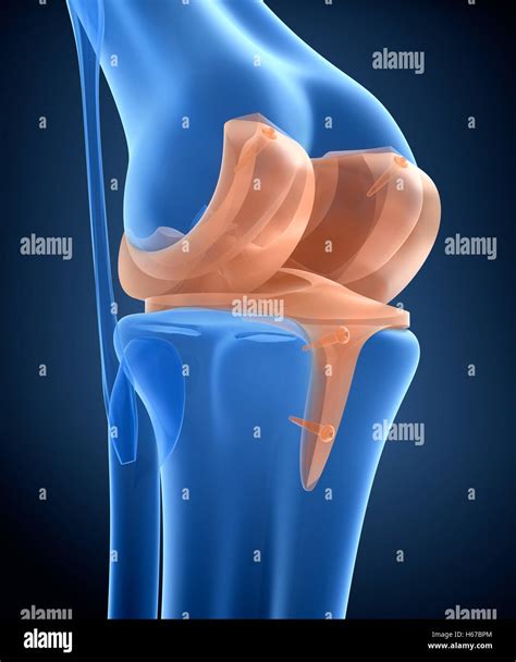 Knee and titanium hinge joint. X-ray view. 3D illustration Stock Photo - Alamy