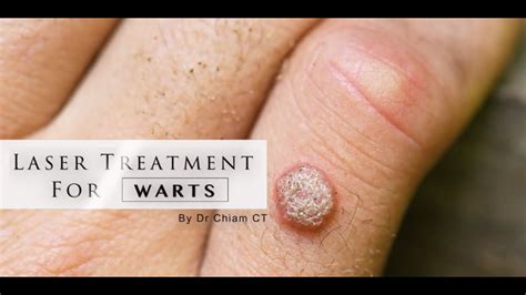 Warts removal with Laser Treatment | Dr. Chiam CT - YouTube