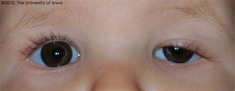 EyeRounds.org: Congenital Ptosis