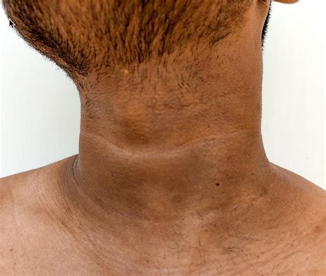 Acanthosis nigricans — Medical Secrets