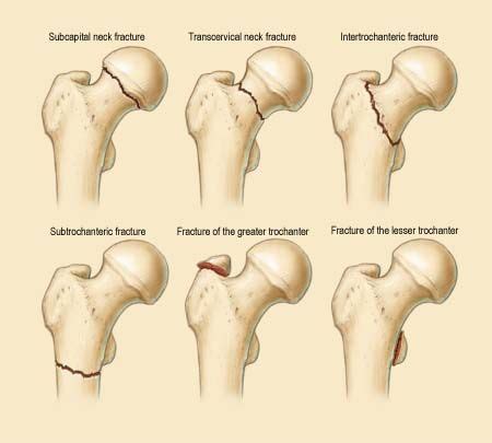 Trochanter