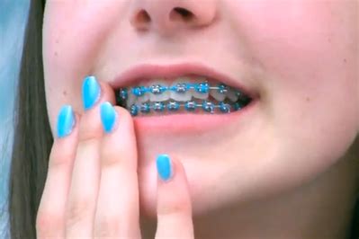 تقويم اسنان الاطفال | Braces colors, Cute braces, Braces tips