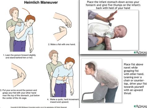 How to Perform the Heimlich Maneuver – Who invented it ? | Heimlich ...