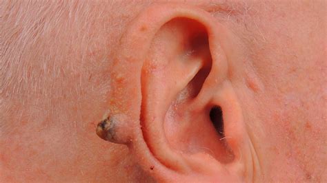 Ear Cancer: Types, Symptoms, Causes, Treatments, and More