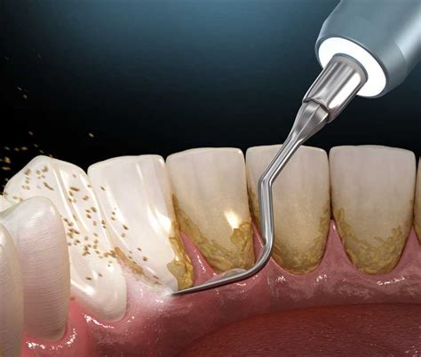 What Is Dental Plaque? - Northern Dental Design