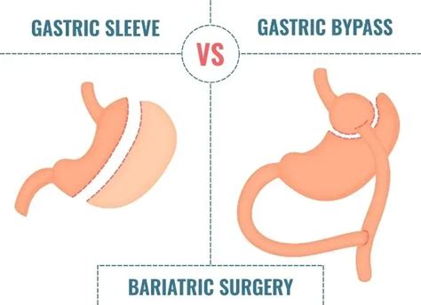 Gastric Sleeve Vs. Gastric Bypass: What’s The Difference | Bariatric and Minimally Invasive ...